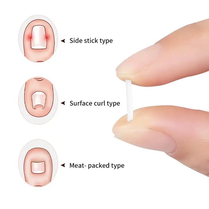 Outil de Correction des ongles incarnés, 100 pièces, traitement des ongles incarnés, Patch élastique autocollant, Clip de redressage, attelle, outil de pédicure