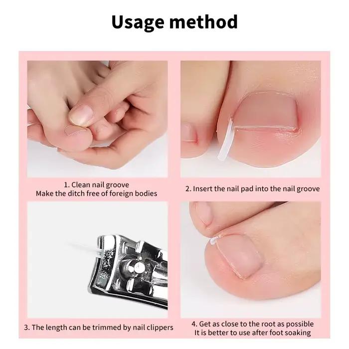 Outil de Correction des ongles incarnés, 100 pièces, traitement des ongles incarnés, Patch élastique autocollant, Clip de redressage, attelle, outil de pédicure