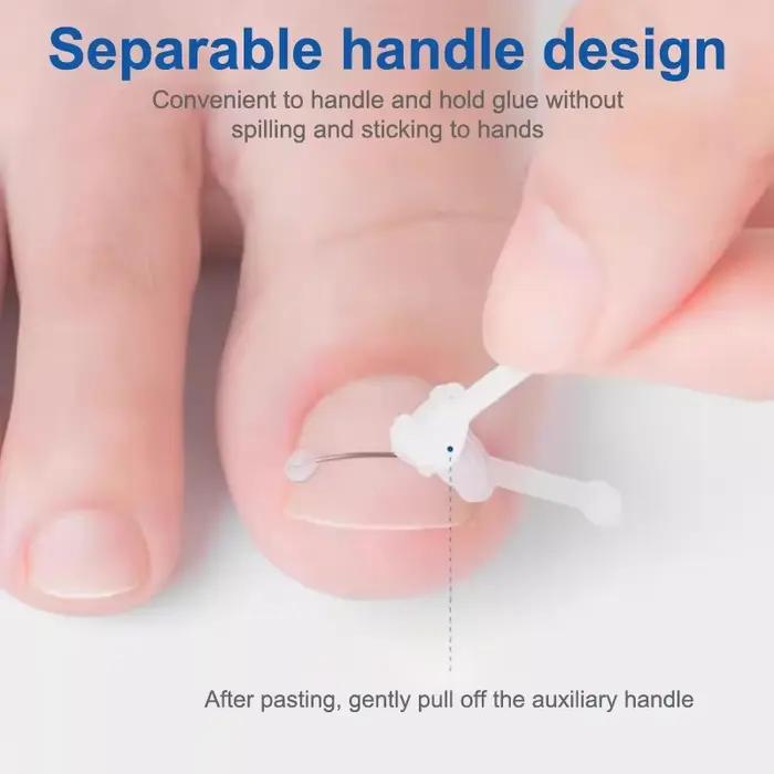 Soins des ongles outil de Correction des ongles incarnés traitement des ongles des orteils incarnés Patch élastique autocollant redressage pince orthèse pédicure aussi