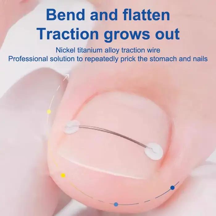 Outil de Correction des ongles incarnés, traitement des ongles incarnés, Patch élastique autocollant, Clip de redressage, outil de pédicure