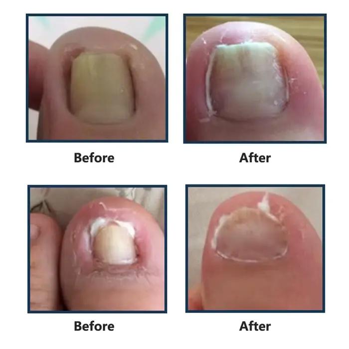 Outil de traitement des ongles incarnés, crochet à ongles, fil d'acier, pince à lisser, paronyamitié, pédicure