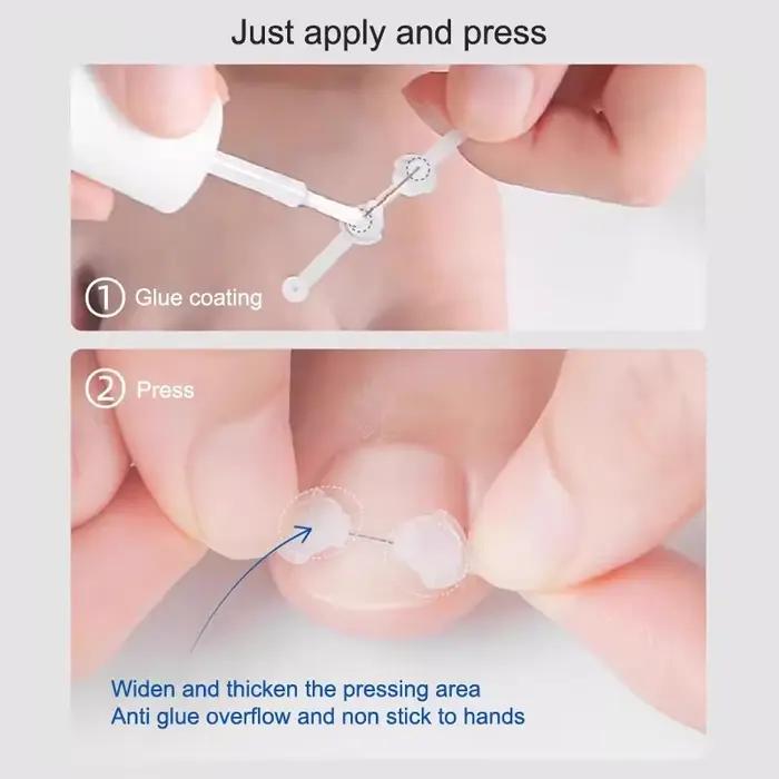 Soins des ongles outil de Correction des ongles incarnés traitement des ongles des orteils incarnés Patch élastique autocollant redressage pince orthèse pédicure aussi