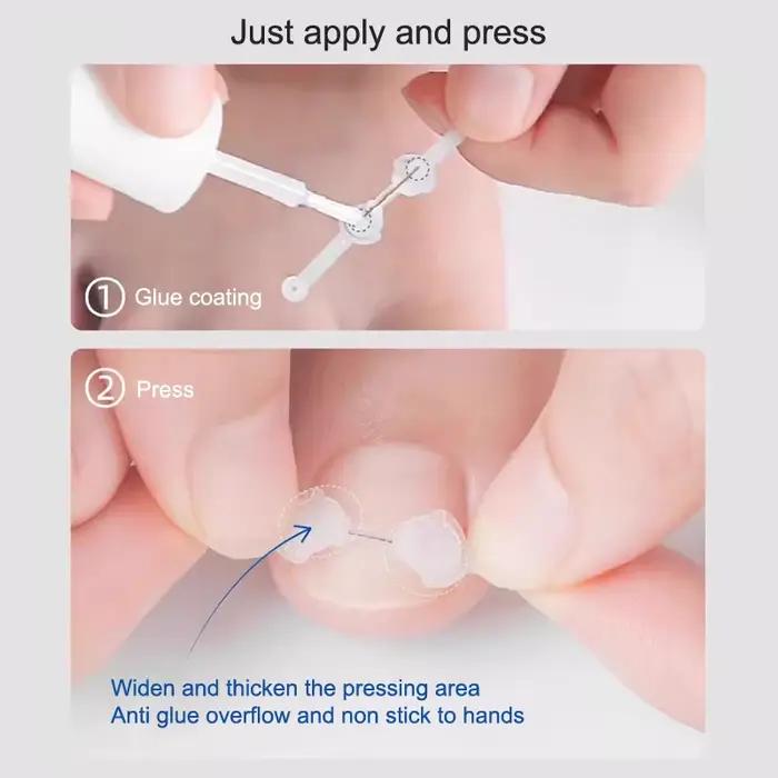 Correcteur d'ongles incarnés 12/14/16/18mm, traitement des ongles incarnés, Patch élastique autocollant, Clip de redressage, outil de pédicure