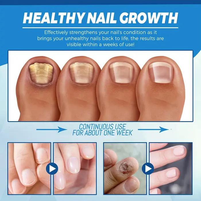 EELHOE – dispositif Laser fongique pour ongles, avec Relaxation des champignons, dispositif de soins pour l'onychomycose, pour réparer les cuticules des ongles des pieds, P K9B9