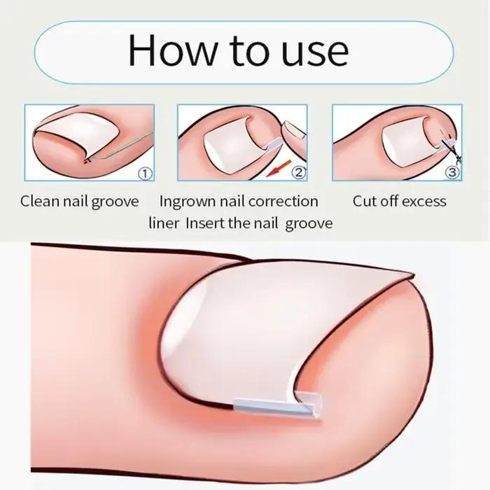 Outil de Correction des ongles incarnés, traitement des ongles incarnés, Patch élastique autocollant, Clip de redressage, outil de pédicure, 10 à 50 pièces