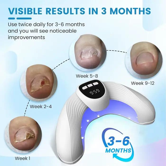 Appareil laser de réparation des ongles, traitement anti-infection pour onychomycose des ongles de pieds et des mains, paronychie, ongles incarnés, usage domestique