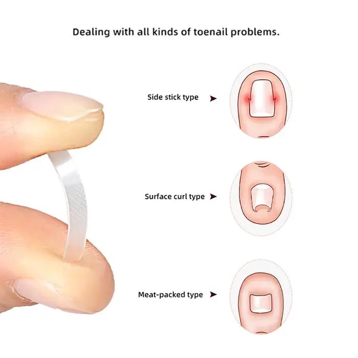 Traitement des ongles incarnés, outil de Correction des ongles incarnés, Patch élastique autocollant, Clip de redressage, attelle, outils de pédicure, 10 pièces