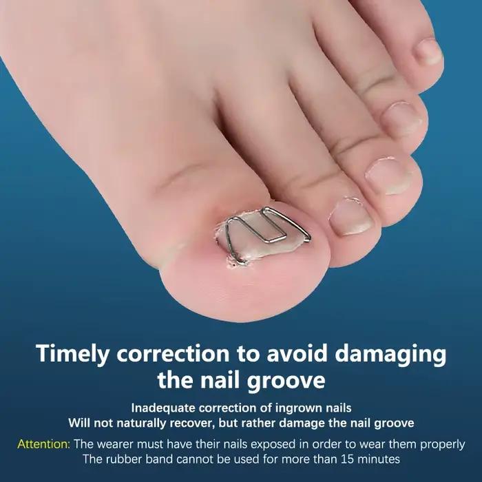 Outil de traitement des ongles incarnés, crochet à ongles, fil d'acier, pince à lisser, paronyamitié, pédicure