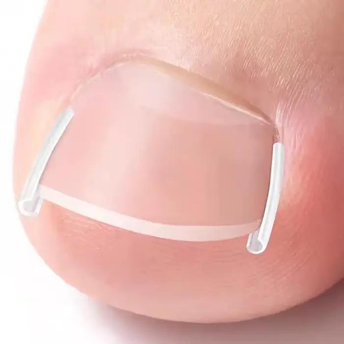 Outil de Correction des ongles incarnés, 50 pièces, tampon de traitement des ongles incarnés invisibles, rainure, Clip de redressage, attelle, outil de soins des pieds