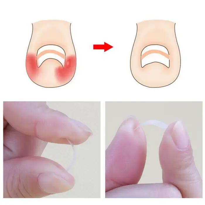 Outil de Correction des ongles incarnés, 100 pièces, traitement des ongles incarnés, Patch élastique autocollant, Clip de redressage, attelle, outil de pédicure
