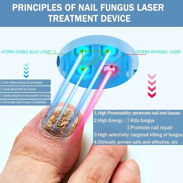 Dispositif de traitement au Laser pour champignons des ongles, réparation des champignons des ongles des pieds, traitement des champignons, onychomycose, ongles au Laser avec Relaxation des champignon