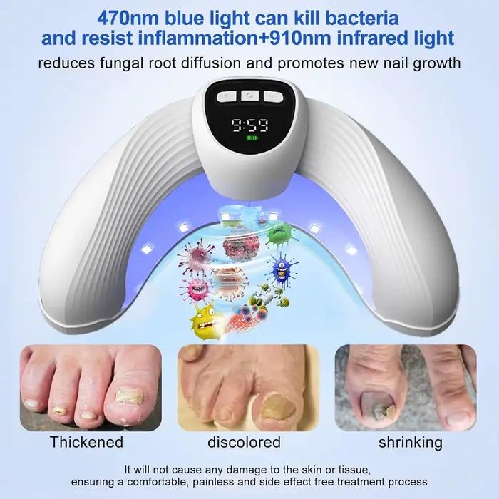 Appareil laser de réparation des ongles, traitement anti-infection pour onychomycose des ongles de pieds et des mains, paronychie, ongles incarnés, usage domestique